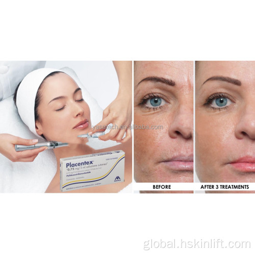 Cindella Anti Aging Skin booster Mesotherapy Placentex skin rejuvenation Supplier
